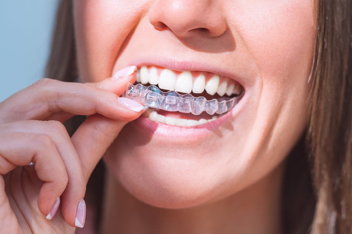 Clear Aligners Full Treatment: Transform Your Smile Fast and Safely ...