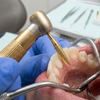 Gold Diamond Burs for Enamel Reduction: The Complete Clinical Reference