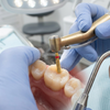 Gold Diamond Burs for Composite Restoration: The Complete Clinical Guide