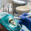Dental Burs for Amalgam Removal: The Complete Clinical Reference